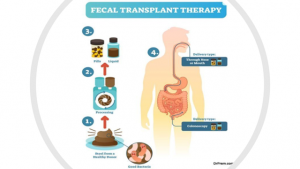 Faecal Transplant Therapy process