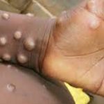 WHO Declares Mpox Global Public Health Emergency, As Sweden Confirms First Case