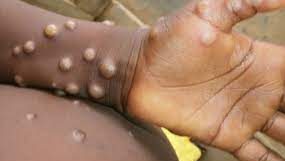 WHO Declares Mpox Global Public Health Emergency, As Sweden Confirms First Case