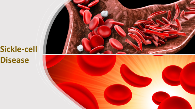 Gene Therapy Technology For Sickle-cell Disease Treatment