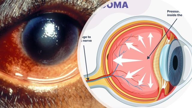 Genetic Revelation Of Glaucoma Risk Factors In People Of African Descent