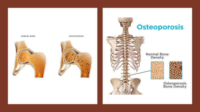 Lactation Hormone May Be Key To Osteoporosis Treatment